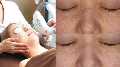 美容医療初心者におすすめ♡ 憧れの美白肌が叶う「トーニング＆IPL」って？