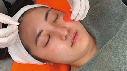 オールラウンドに効く！はじめての美容医療におすすめの【ピーリング】って？