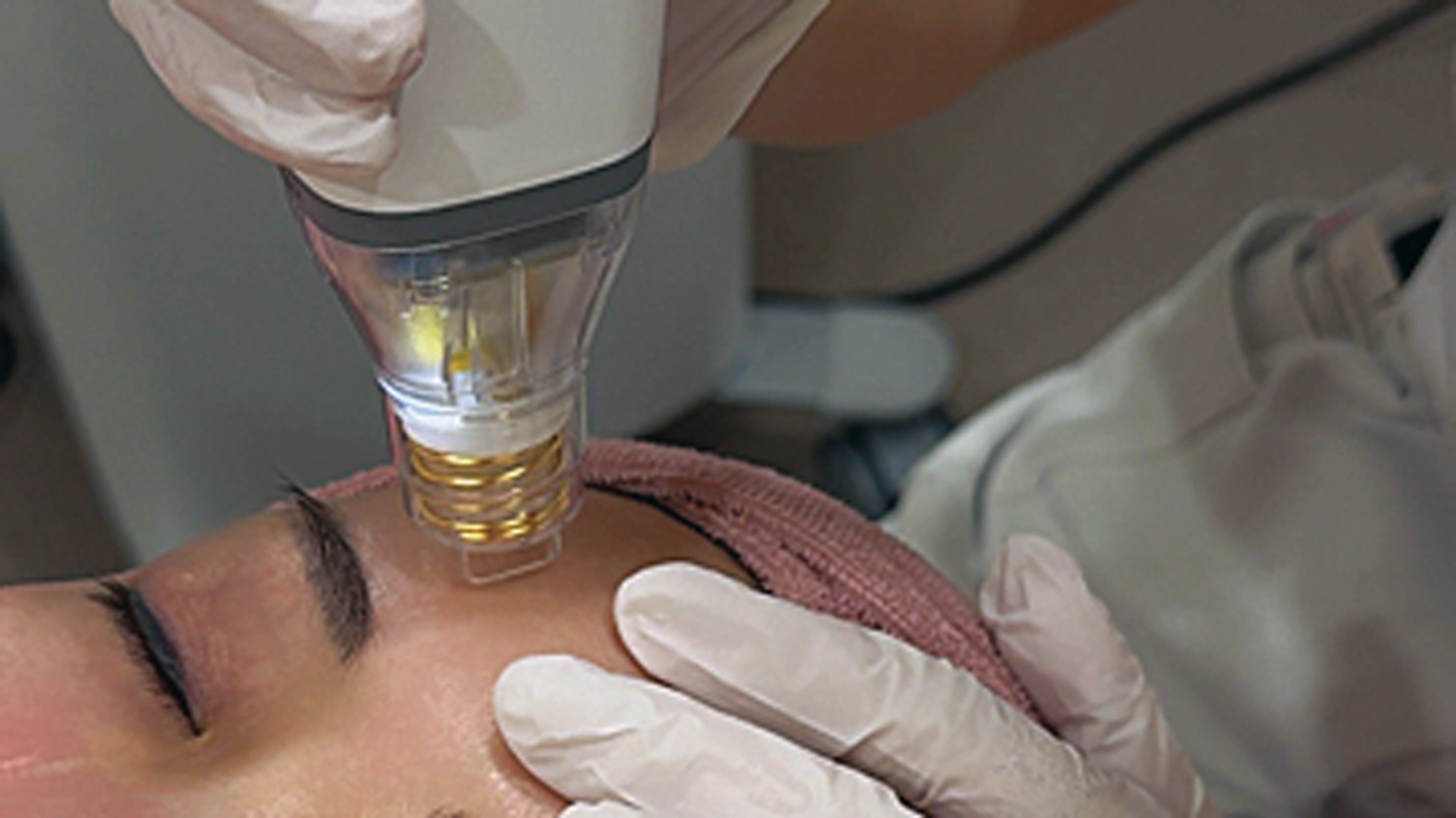 【美容医療】ニキビあとに悩む方必見!初心者さんにおすすめの「ポテンツァ&エレクトロポーション」